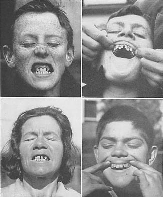 niezdrowe zęby